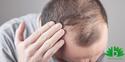 Alopecia: symptomen en behandelen