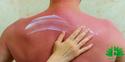 Wat helpt tegen verbrande huid?